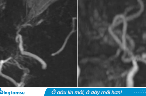 Hình ảnh MRI khiến bác sĩ bất ngờ: Mạch máu não bệnh nhân mờ như “khói thuốc”