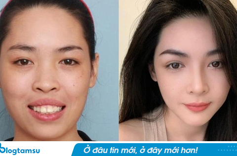 10 năm sau ca phẫu thuật “thay đầu” thành công nhất Việt Nam: Nữ chính được trao thân phận khác nhưng có 1 điều gây tiếc nuối