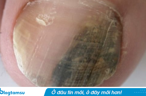 Căn bệnh UT tiên lượng xấu có thể bắt đầu từ một dải đen, thẳng ở móng