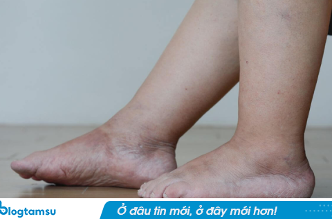 Khi gan suy nặng, cơ thể sẽ sưng ở 5 chỗ: Có 1 cũng nên đi khám ngay