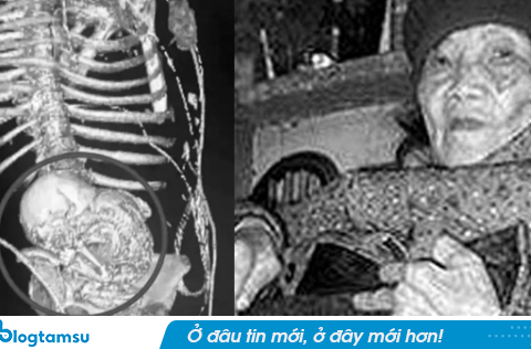 Chụp CT cho cụ bà 73 tuổi, bác sĩ sốc nặng khi phát hiện thai nhi hóa đá 30 năm