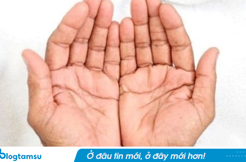 Người có gan suy yếu thường có những dấu hiệu này ở bàn tay nhưng ít được chú ý